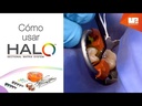 Kit de matriz seccional HALO  - Bandas - #4832 - Ultradent