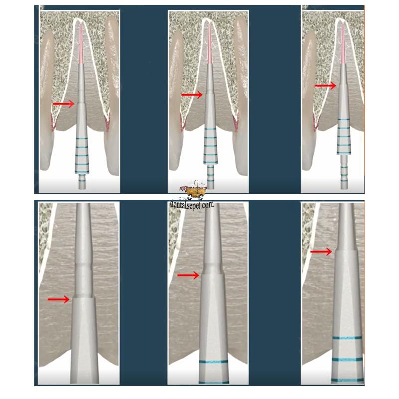 Kit de Postes de Fibra de Vidrio (5 posTes con Funda + 1 Fresa) - ANGELUS