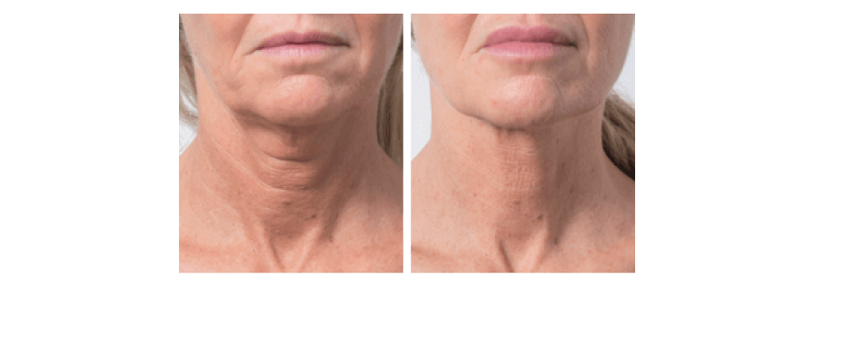 Profhilo - Jeringa 2 ml Ac. Hialurónico - IBSA