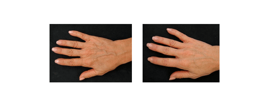 Profhilo - Jeringa 2 ml Ac. Hialurónico - IBSA