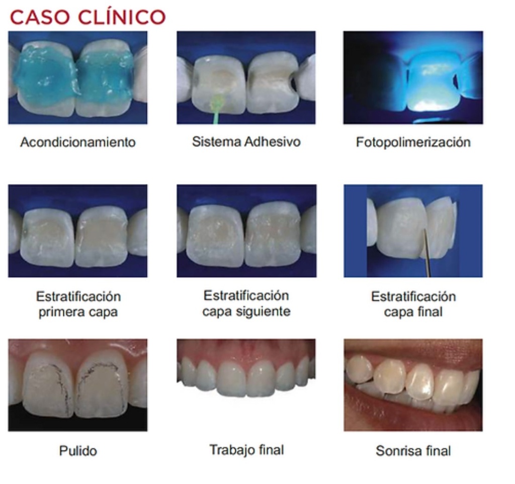 Composite  Ultra Fill -varios colores - 4g - ULTRA