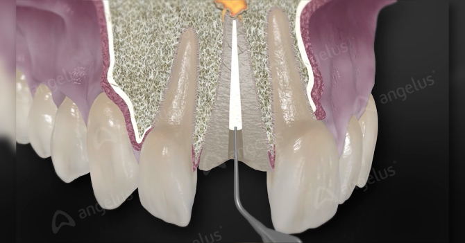 Cemento endodóntico Obturador Bioceramico BIO C SEALER (0,5g) - Angelus