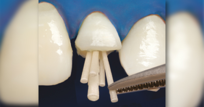 Postes de Fibras de Vidrio REFORPIN x 5 o 10 unidades - Angelus