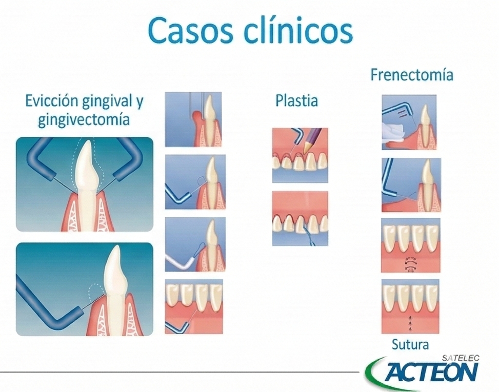 Electrobisturí con 10 electrodos - Servetome - Acteon