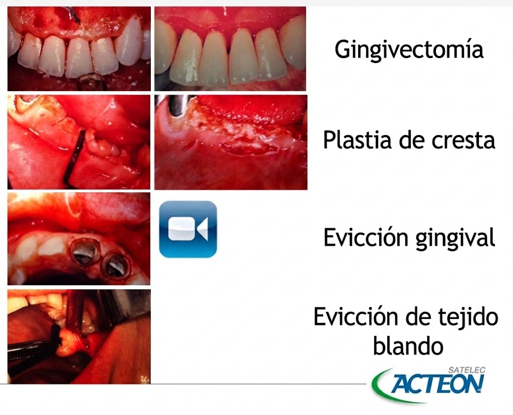 Electrobisturí con 10 electrodos - Servetome - Acteon
